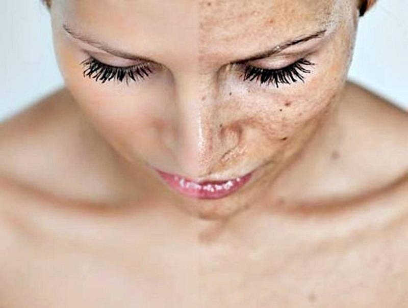 PEELING QUIMICO BOGOTA IBAGUE PEELING QUIMICO BOGOTA IBAGUE