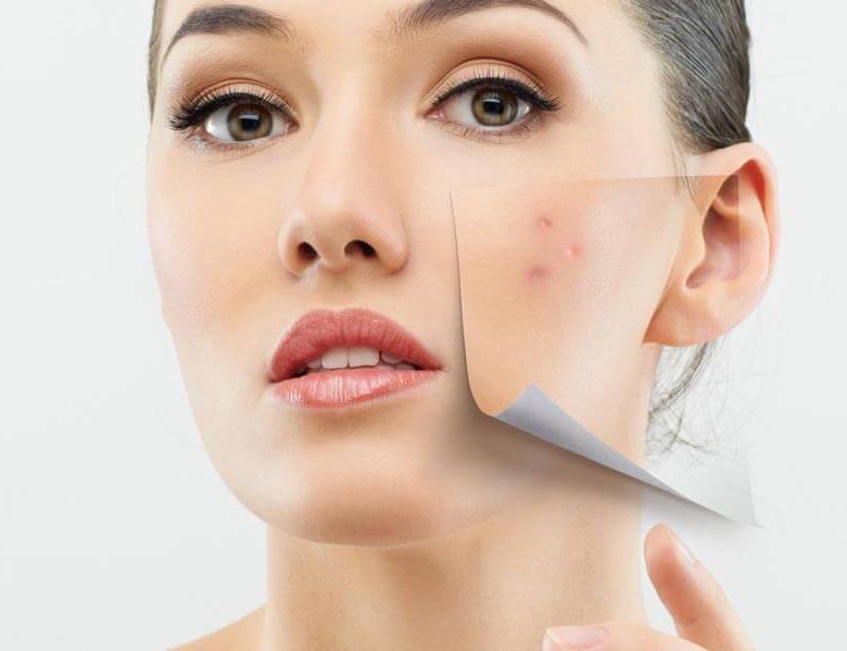 tratamiento para el acne bogota